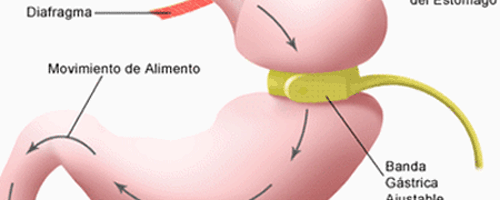 ¿Cuándo se debe considerar la cirugía bariátrica?
